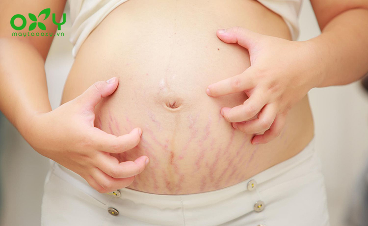 Tình trạng ngứa da có thể xuất hiện khi mang thai do bụng ngày càng căng ra