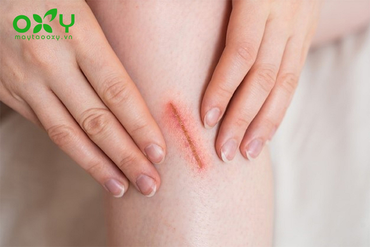Vết thương hở xuất hiện khi da bị rách, đâm thủng, cắt hoặc được mổ và dễ thấy