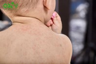 5 Mẹo dân gian chữa sốt phát ban cho bé hiệu quả tại nhà