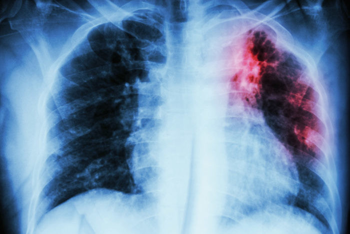 Bệnh lao phổi có lây nguy hiểm và chữa được không