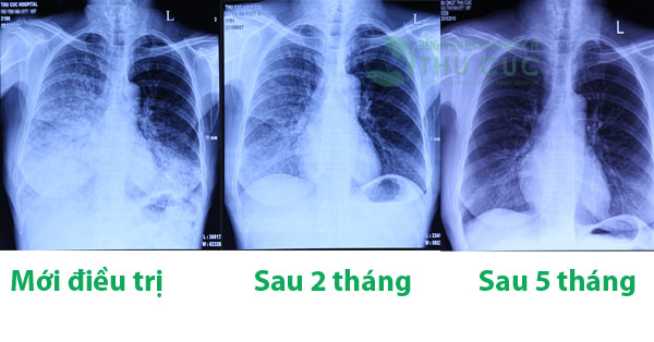 Bệnh Lao Phổi Có Đi Làm Được Không? Hướng Dẫn Từ A Đến Z Cho Người Bệnh