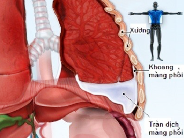 3. Bệnh tràn dịch màng phổi có lây không?